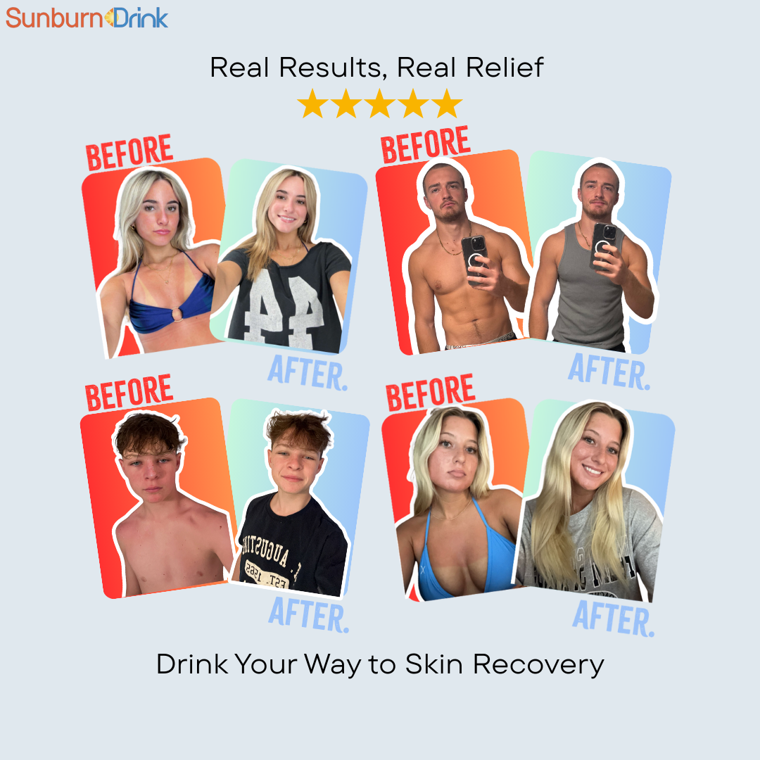 Sunburn Drink 20 Pack, Zero Sugar After Sun Hydration