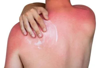 How to Treat a Painful Sunburn?