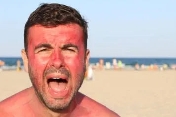 Sunburn Blisters on Face: Causes, Symptoms, Complications and Treatment