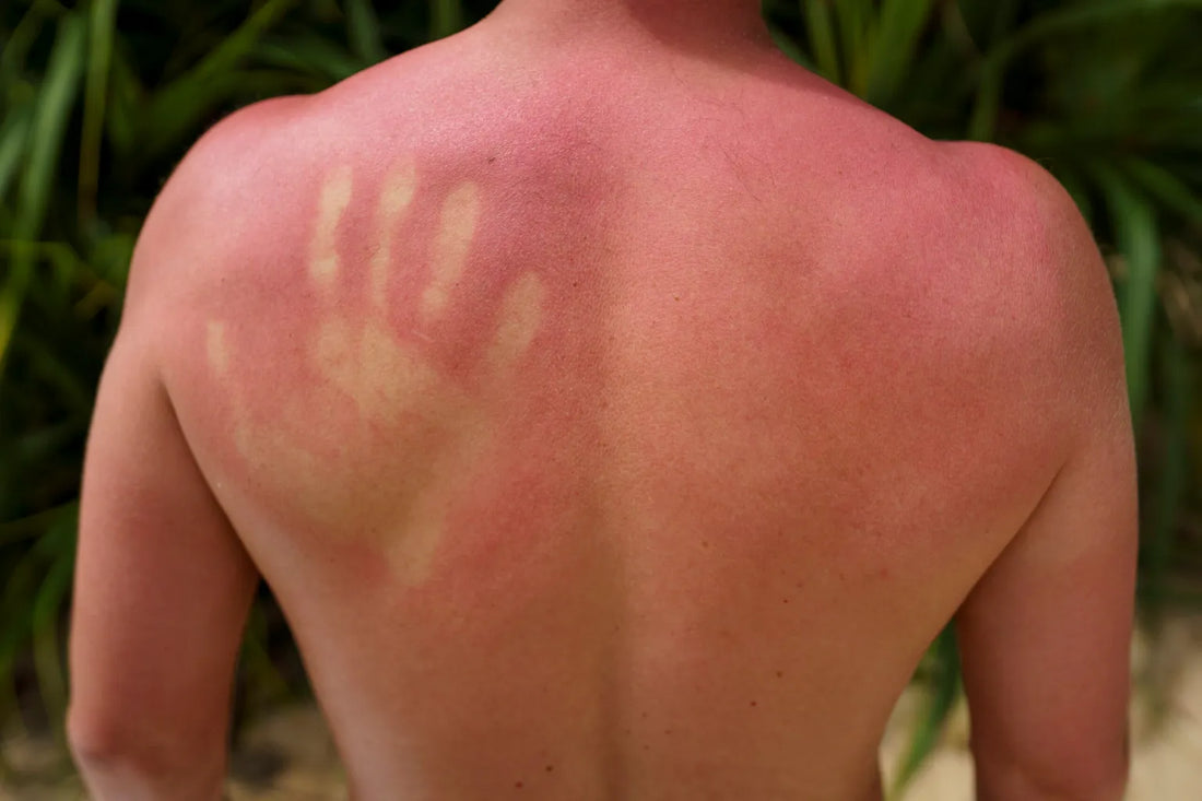 How long can the Worst Sunburn Case Last?