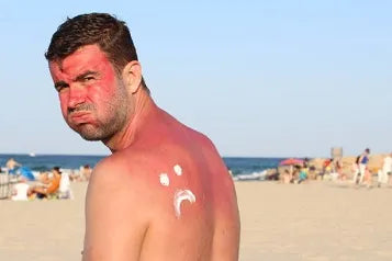 Understanding the Complications of Sunburn Blisters