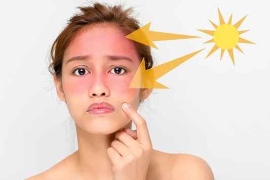 SUNBURN: SYMPTOMS, CAUSES, AND TREATMENTS