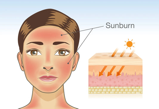 Follow The Sunburn Science