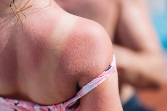 What You Should Know About Sunburn Blisters